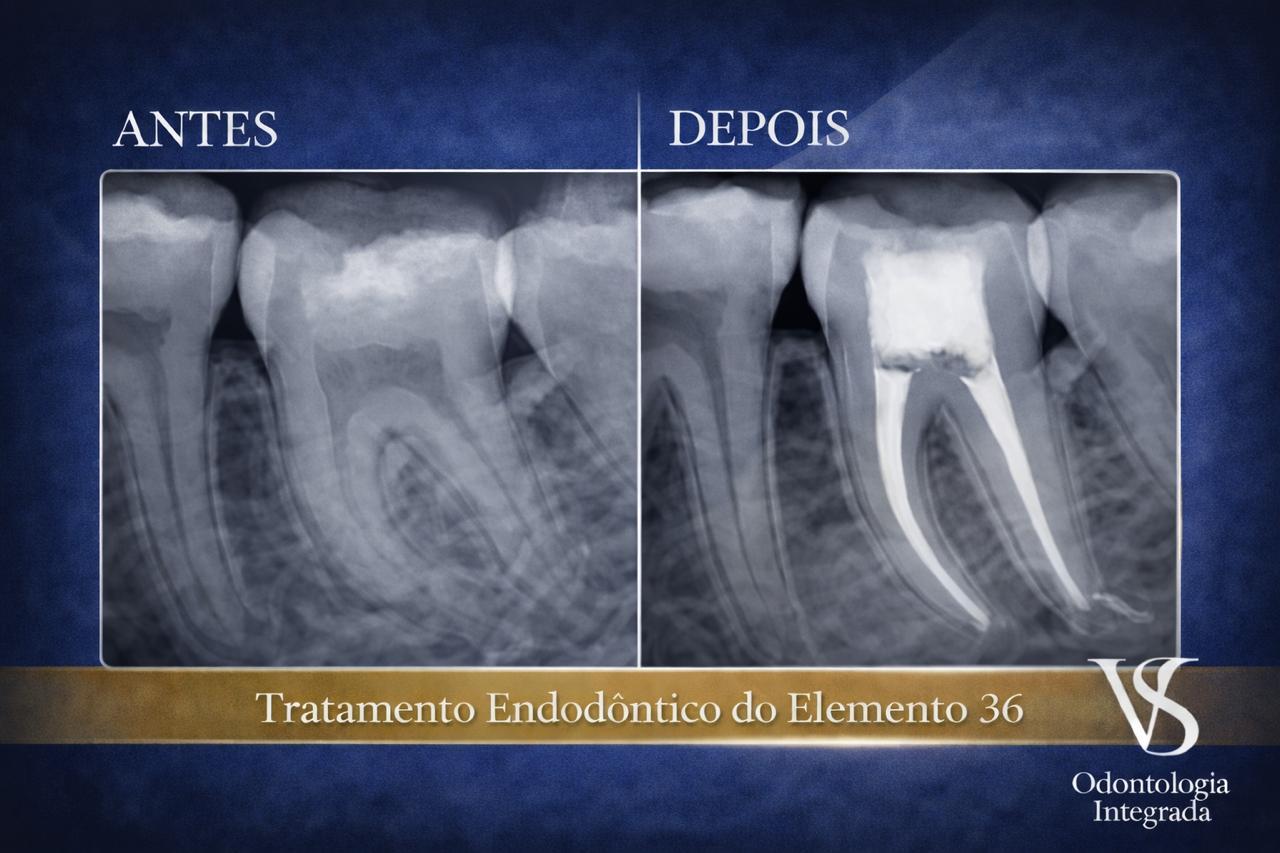 Procedimento de tratamento endodôntico