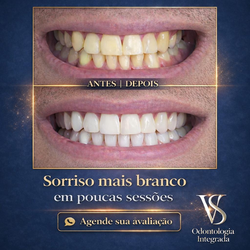 Resultado de clareamento dental